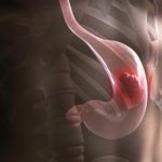 «Изменение пищевых привычек»: учёные — о неявных симптомах рака желудка и выявлении заболевания